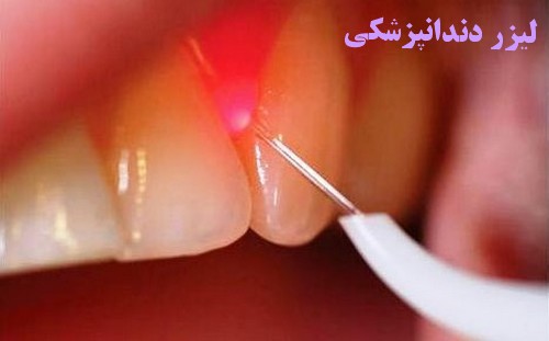 دندانپزشکی لیزری در انواع روش ها استفاده می شود ، از جمله: