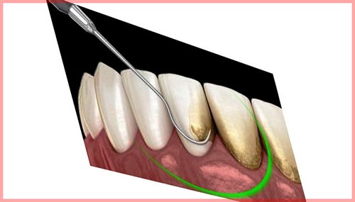 جرم گیری دندان چیست و چه کسانی باید ان را انجام بدهند