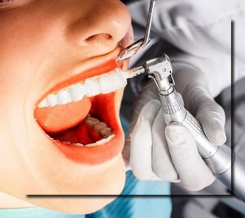 جرم گیری دندان چیست و چه کسانی باید ان را انجام بدهند