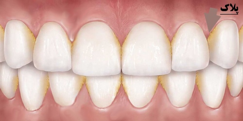 پلاک دندان چیست درمان پلاک چگونه صورت میگیرد