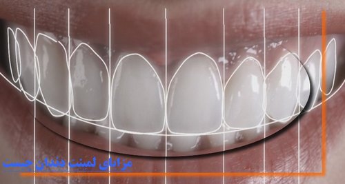 مزایای واقعی لمینت دندان چیست