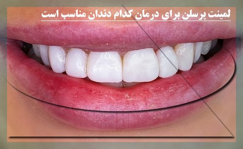 لمینت پرسلن برای درمان کدام دندان مناسب است 