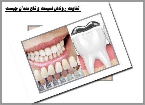 تفاوت روکش لمینت و تاج دندان چیست :