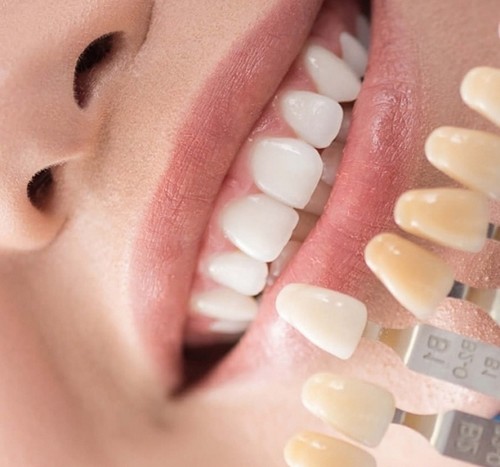 لمینت دندان یک پوسته نازک است که از سرامیک ساخته شده .