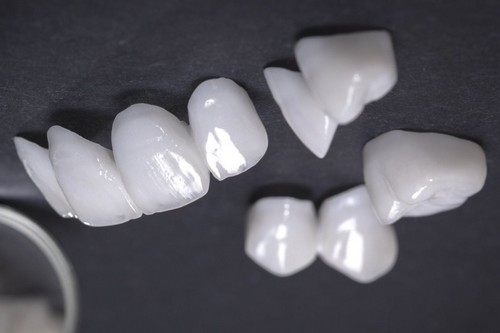 لمینت دندان یک پوسته نازک است که از سرامیک ساخته شده .