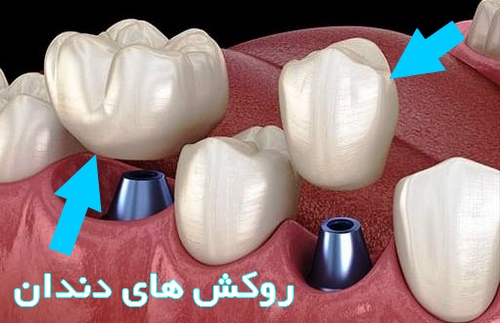 روکش های دندان چگونه هستند آیا مشکلاتی هم دارند