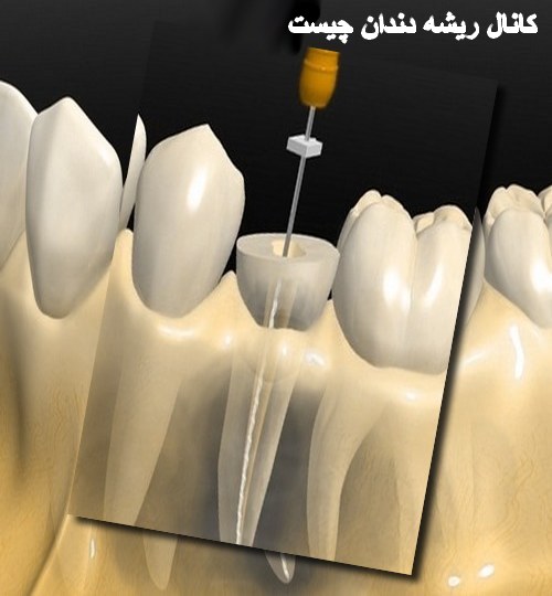کانال ریشه دندان چیست+چرا درمان ریشه ضروری است