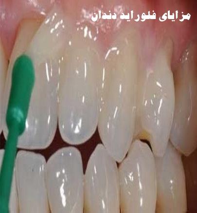 مزایای فلوراید دندان چیست معایب فلوراید چیست