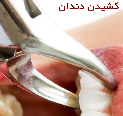 علائم عفونت پس از کشیدن دندان 