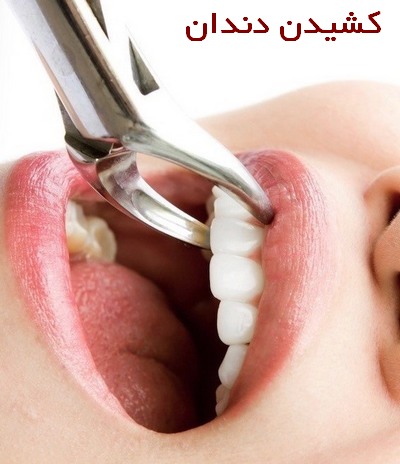 ایا کشیدن دندان خطر دارد+علائم عفونت پس از کشیدن دندان