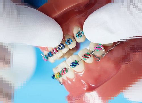 دندان ارتودنسی  چیست یعنی چه + انواع ارتودنسی بهترین نوع بریس های ثابت