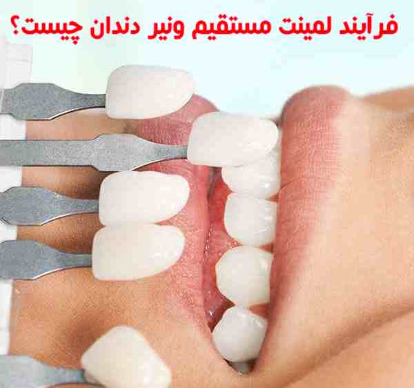 فرآیند لمینت مستقیم ونیر دندان چیست؟