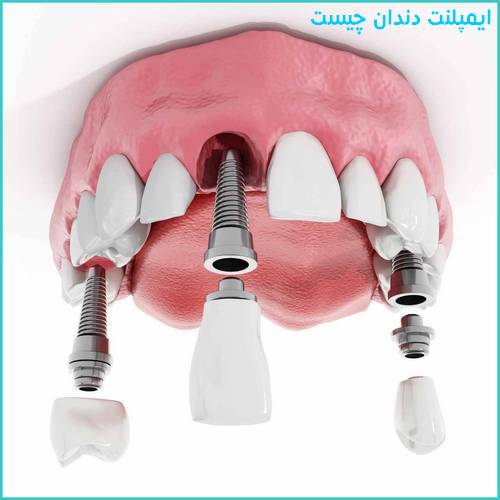 ایمپلنت دندان  بهترین جایگزین دندان از دست رفته است + توضیحات دقیق و کوتاه