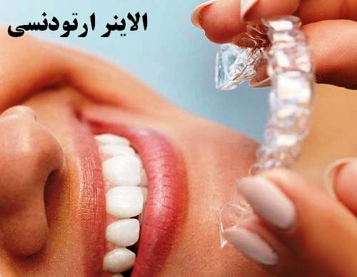 الاینر ارتودنسی در روز باید چند ساعت استفاده شود+توضیحات موشکافانه