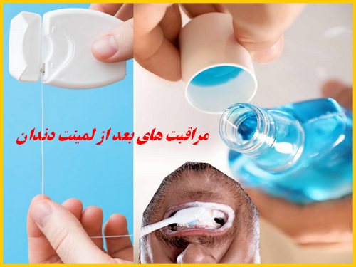 مراقبت های بعد از لمینت دندان 