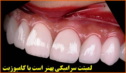 لمینت سرامیکی بهتر است یا کامپوزیت